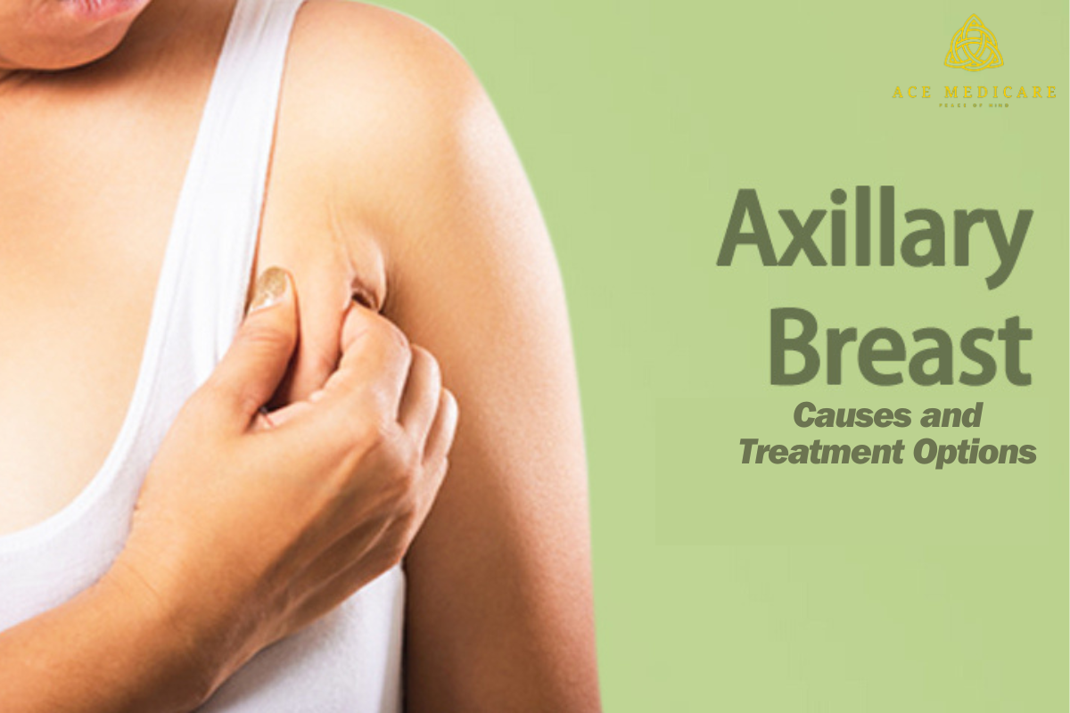 Understanding Axillary Breast Tissue: Causes and Treatment Options